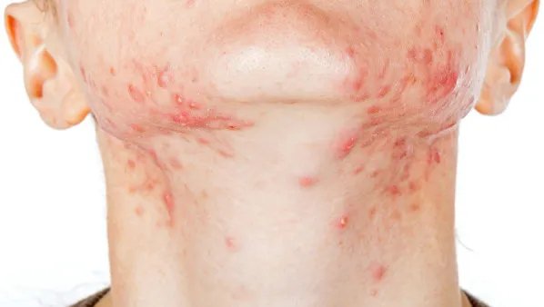 脖子上长痘痘什么原因