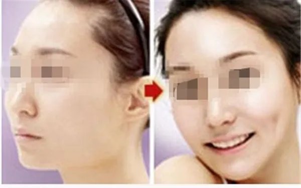 人造酒窝效果好吗？