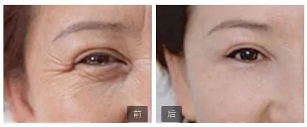 保妥适一针多少钱