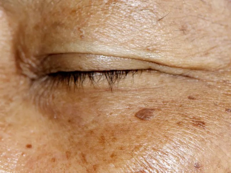 怎样去除面部老年斑