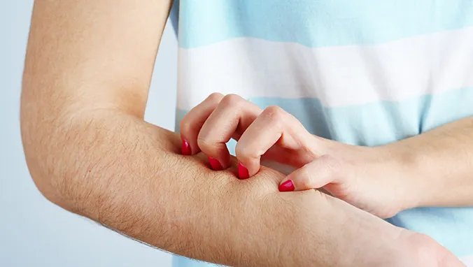 鱼鳞病治疗方法