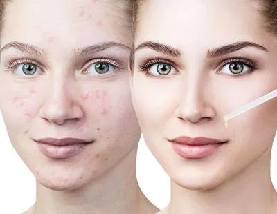 有哪些祛痘秘方