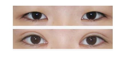 三角眼整形前后对比效果图