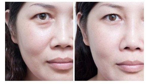 怎么把法令纹去除