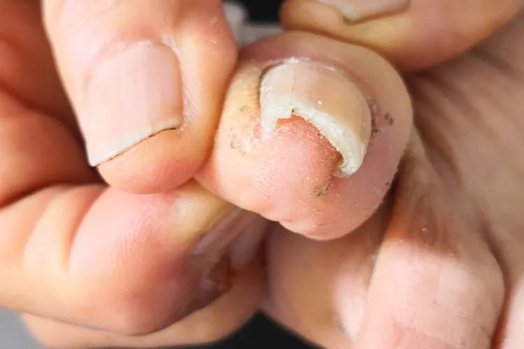 甲沟炎初期图片