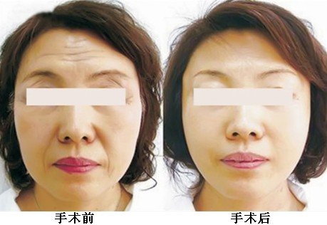 眉头皱纹怎么去除