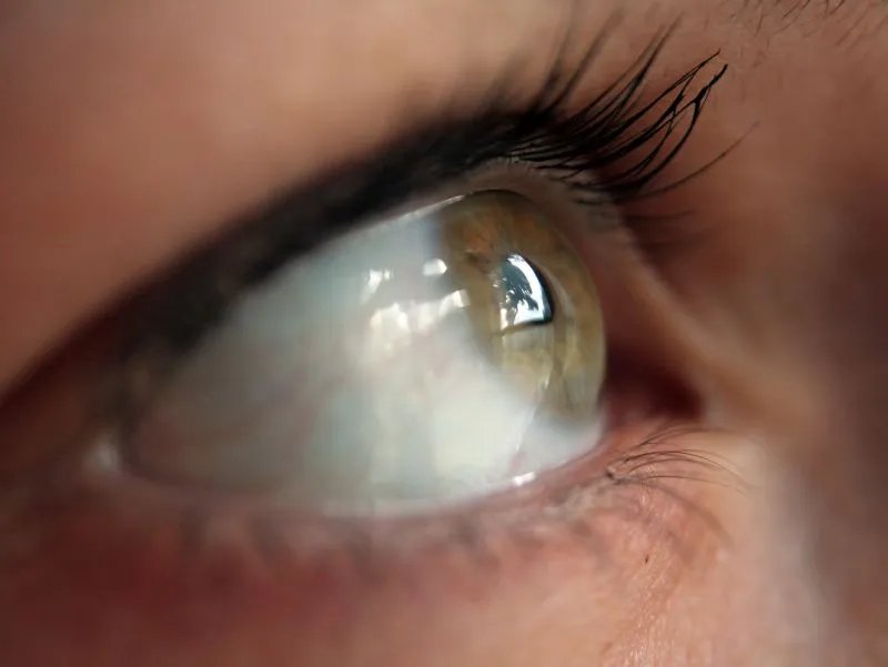 眼睛白斑病是什么病