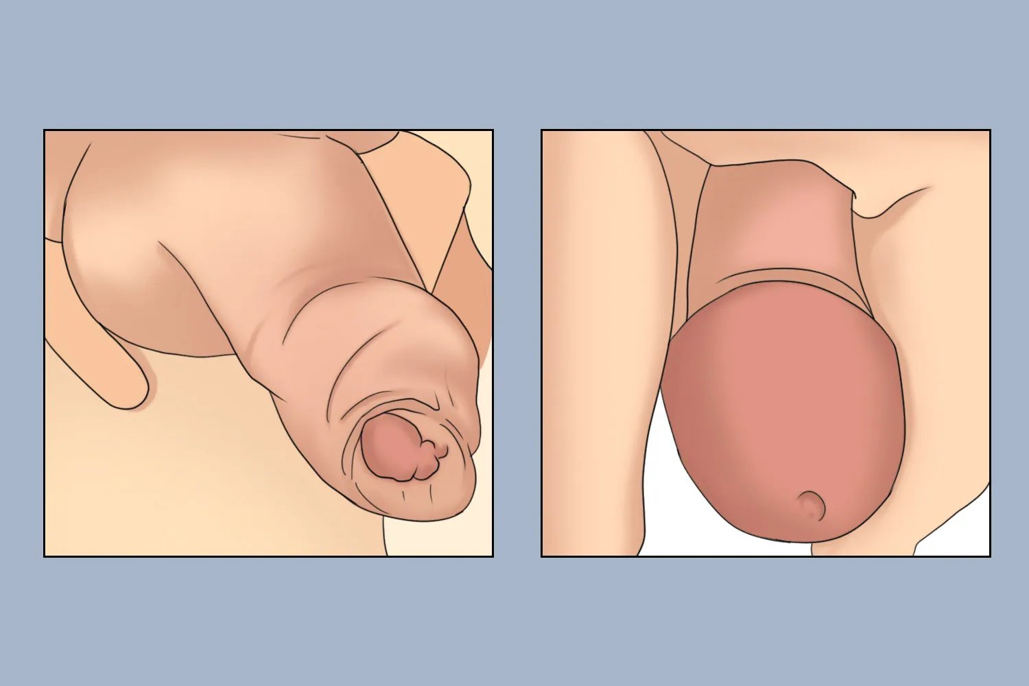 包皮过长的标准的图片