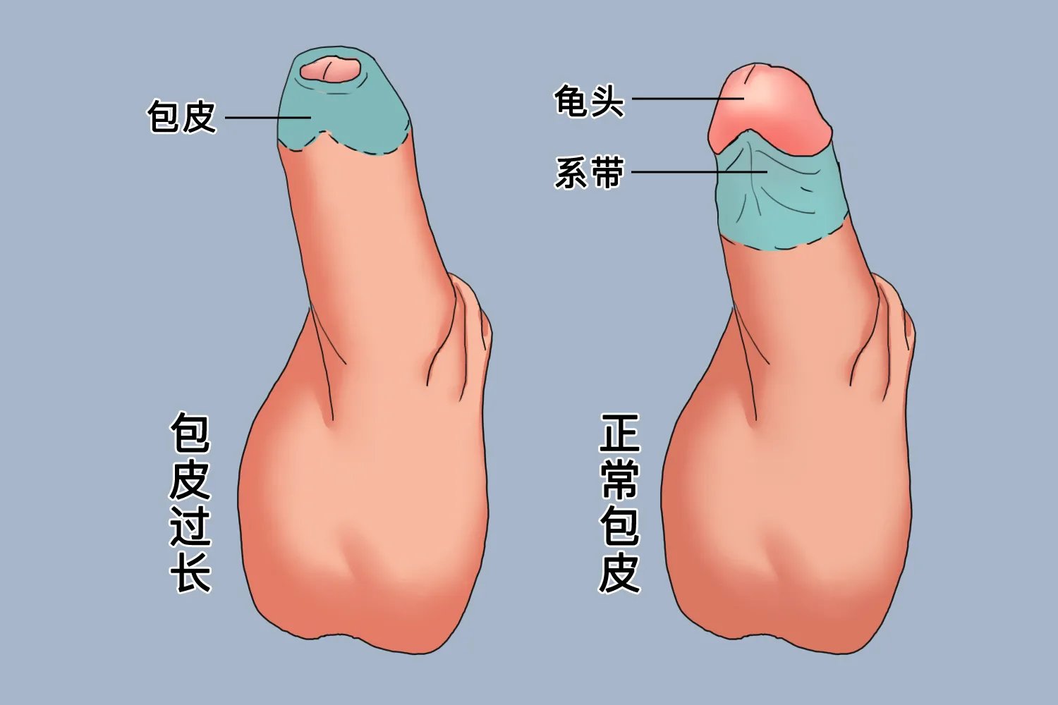 包皮过长的标准的图片