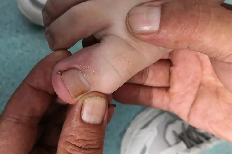 甲沟炎初期图片