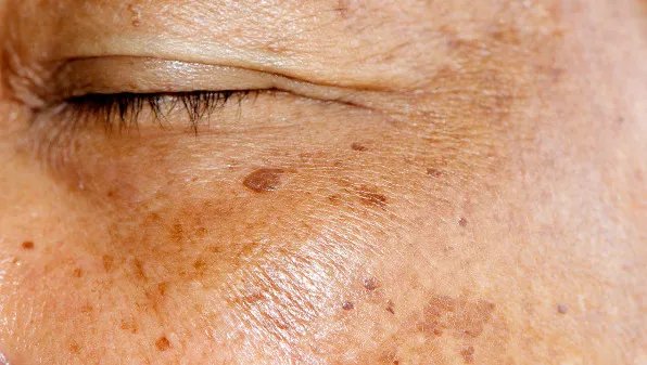 长老年斑是什么原因
