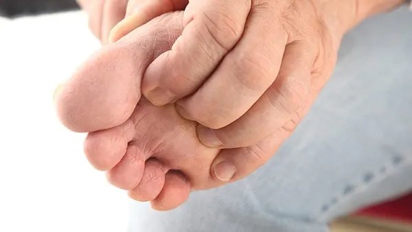 脚脱皮是怎么回事