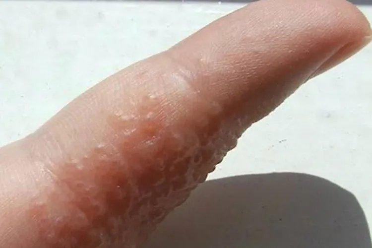 疱疹长什么样子图