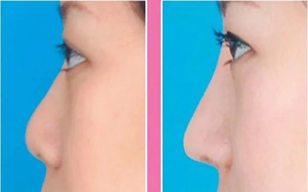 做个隆鼻需要多少钱