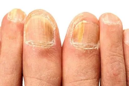 脚趾甲灰指甲图片怎么治