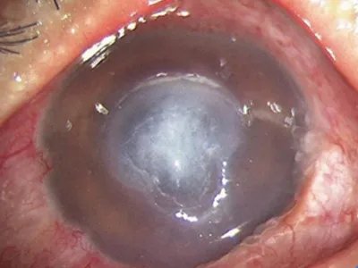 细菌性角膜炎症状图片