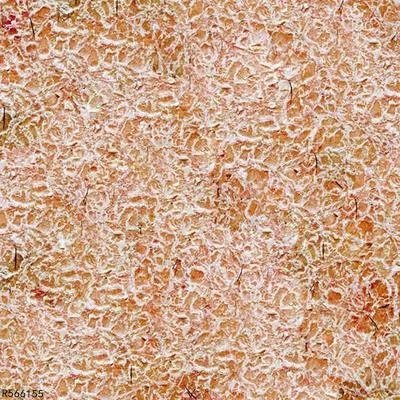 汗斑最严重后果会怎样