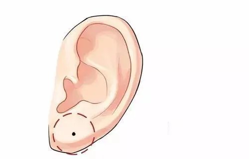 玻尿酸丰耳垂的好处