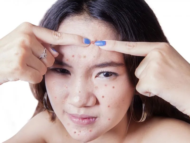 痤疮是什么样的