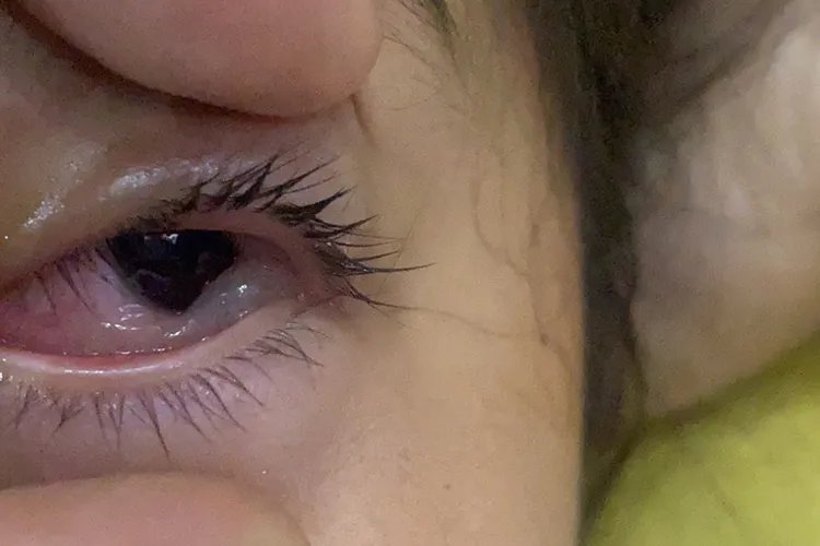 麦粒肿早期图片