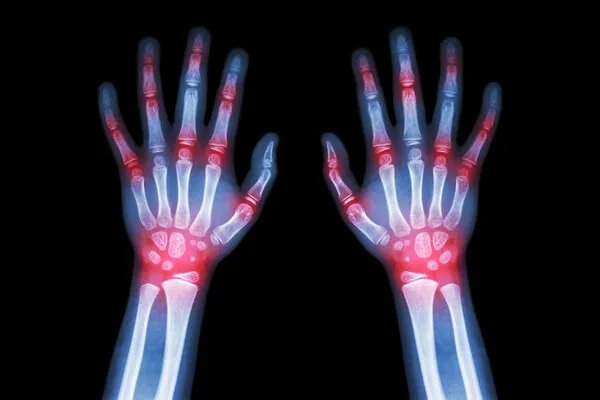 儿童类风湿性关节炎症状能治愈吗