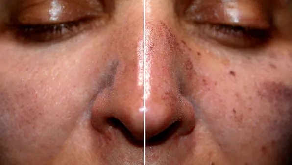 老年斑是怎么回事