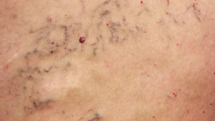 轻度静脉曲张怎么办才好