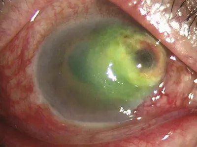 细菌性角膜炎症状图片