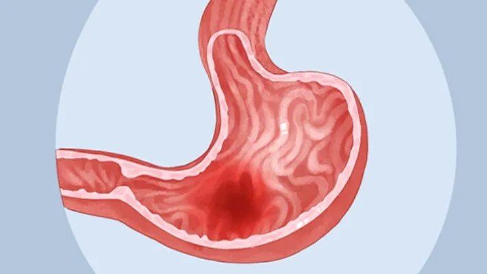 大肠多发息肉严重吗