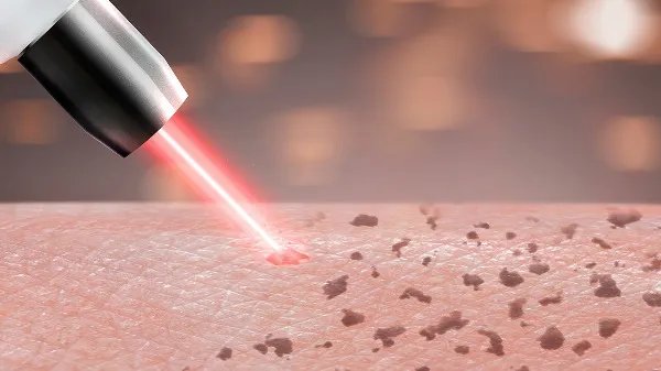 光子嫩肤有效吗