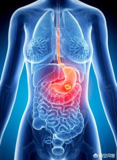 李咏得了什么病？