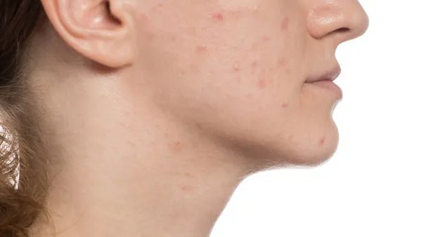 脸上红痘印怎么消除