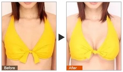 注射玻尿酸丰胸适合哪些人呢