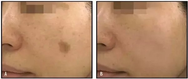 光子嫩肤需要做几次