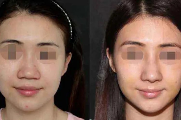 蒜头鼻整形图片对比