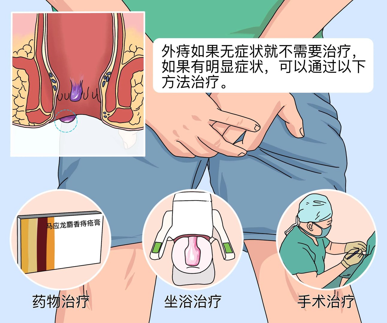 痔疮外痔怎么治疗