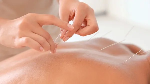 针灸减肥效果好吗