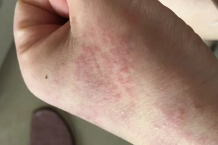 甲醛会导致身体出现哪些状况图片