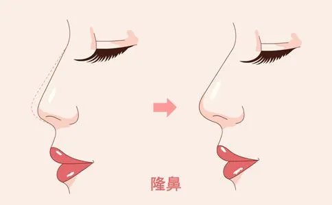 北京垫鼻子的价钱是多少钱