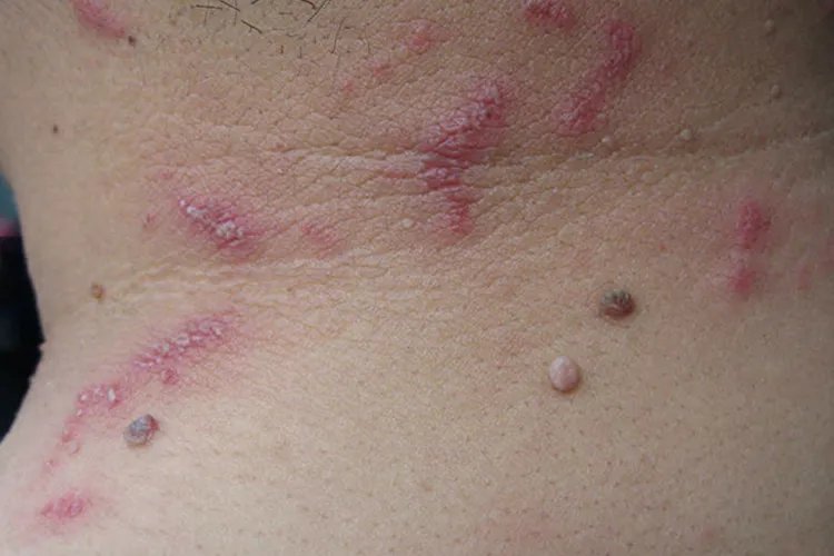 隐翅虫咬人后症状图片