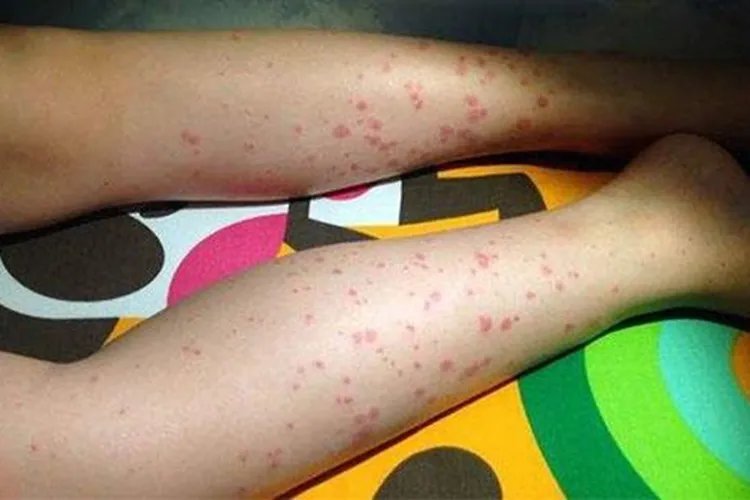 儿童初期紫癜图片