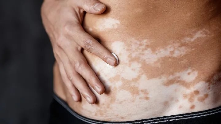 白癜风论坛：白癜风患者论坛上的偏方可靠不