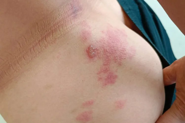 轻度带状疱疹图片