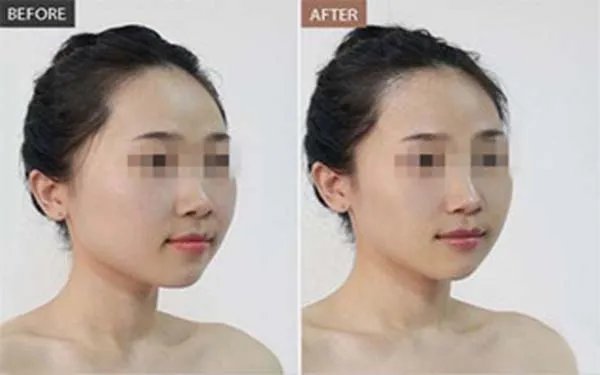 面部填充手术的费用