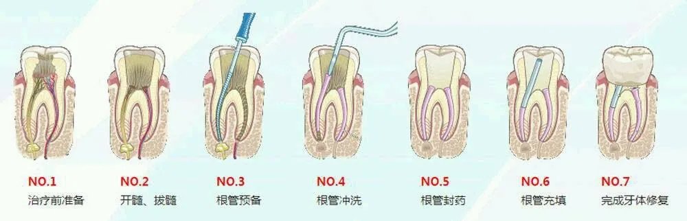 根管治疗