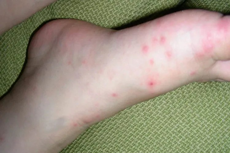 儿童手足口病高清图片