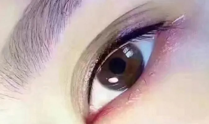 内双割双眼皮价格大概多少