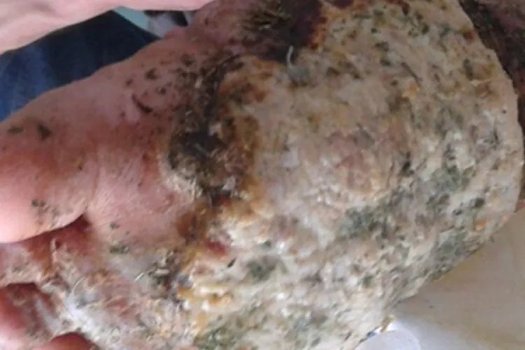 黑素瘤黑斑图片