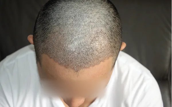 植发价格一般多少钱