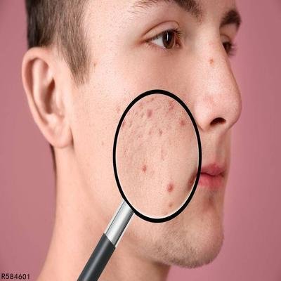 有什么祛痘印的产品效果好